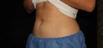 Lower abdomen After